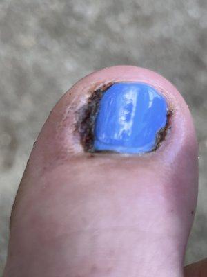 Butchered big toe