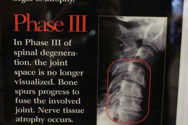 phase 3 of spinal degeneration