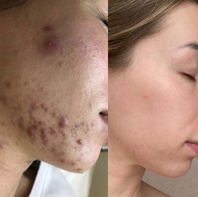 Acne treatment with PlaSon Plasmaporation