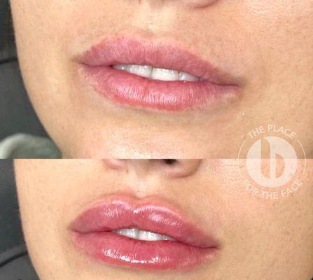 Get the perfect pout with dermal fillers at Bevelup