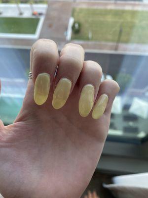 Poorly shaped nails that are longer than the other hand