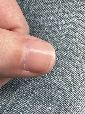 Jagged nail, cuticles ripped up and not removed