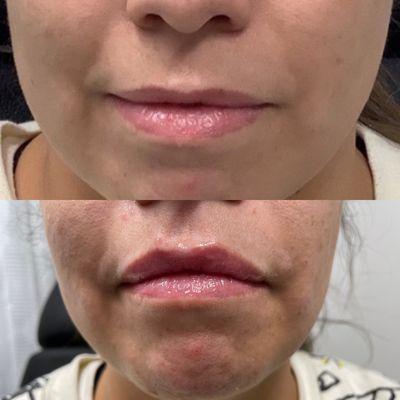 Juvederm Ultra 1/2  cc syringe to fluff these lovely lips