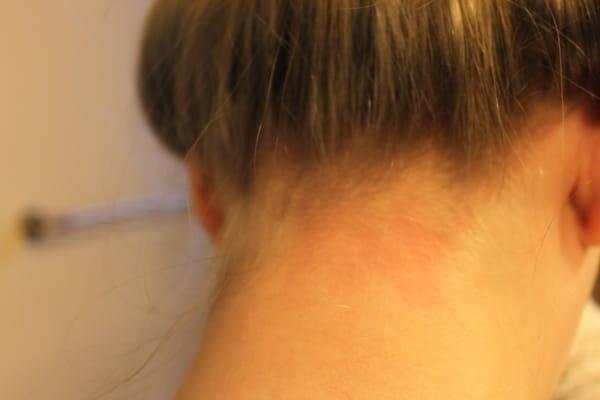 Burn from where my extremely hot hair touched my head mixed with the chemical burn. (after being "serviced" at onyx)