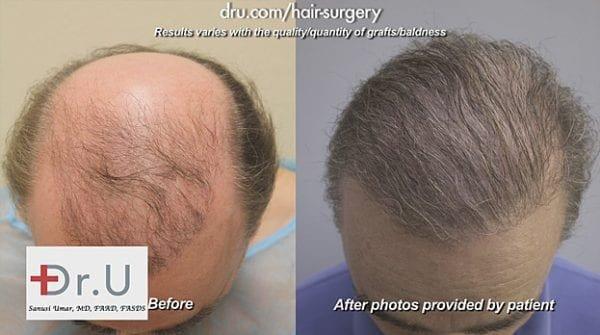 Depleted Donor Supply Rescue - UGraft™ Advanced FUE Hair Transplants - Dr. U Skin & Hair Clinic - Dr. Sanusi Umar, MD Patient Results V1