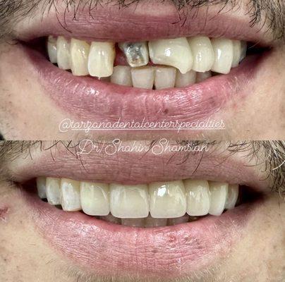 Before & After: Root canal retreatment & a 5 unit Zirconia bridge