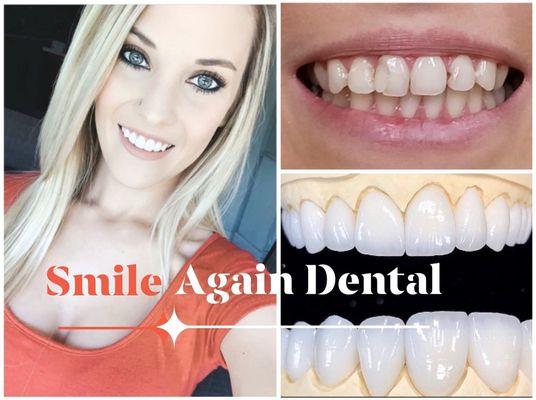 All-porcelain crowns/veneers "Diamond Series."