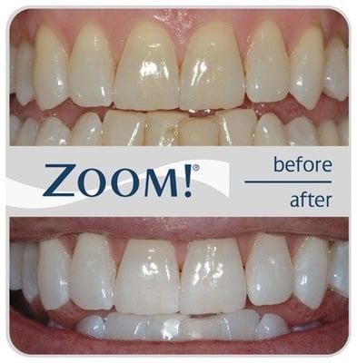 You, too, can have whiter teeth in just one hour!