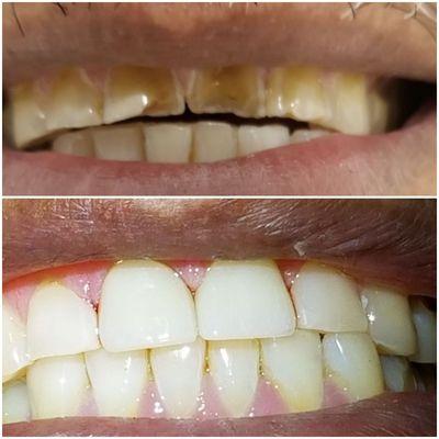 The before  and after dental care.