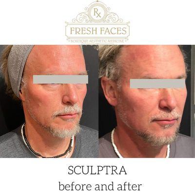 Fresh Faces Rx and Fresh Faces Rx- Lake O injectable beauty treatments (botox, filler, sculptra, qwo, PRF)