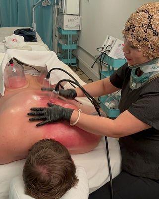 Rita treating a patient with combo Cupping and Gua Sha treatments.