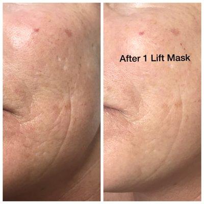 Immediate results after Natural Lift Facial.