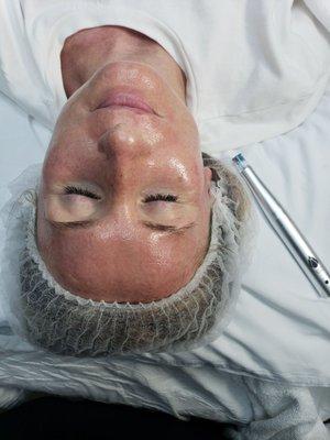 The rezenerate facial after dermaplane leaves skin plump,glowy,tighten,lifted,brighter,smooth/soft with no downtime.