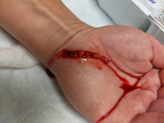 Nurse Rama was upset that I showed I was in pain as he sprayed alcohol on this cut (before the numbing)