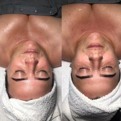 Deep Pore cleansing facial