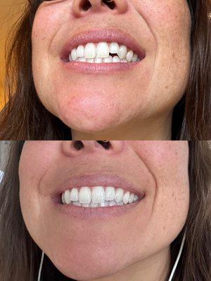 Before and after crown on lateral incisor