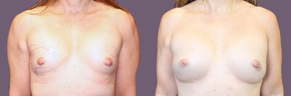 this patient is a 38 year old woman who underwent 360 ml silicone breast implants with a periareolar incision.