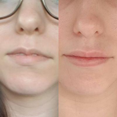 Before and after lip filler