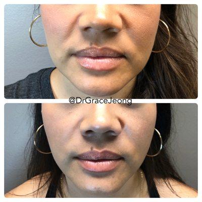 V-line lift with PDO Threads - targets smile lines and sagging jowls. Immediate results No downtime Long lasting effects Minimally invasive