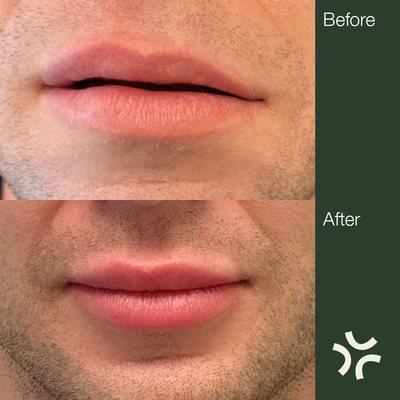 Before and After 
Lip rehabilitation. This patient had migrated and misplaced filler that needed dissolving prior to being filled again.