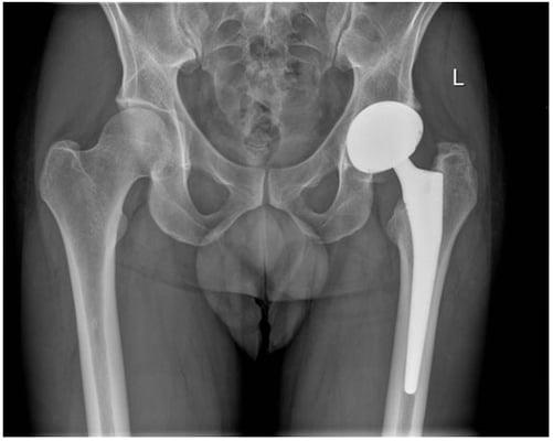 total hip replacement through an anterior approach