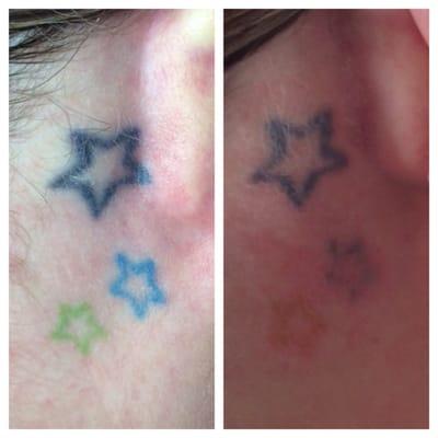 First treatment: Before and after.