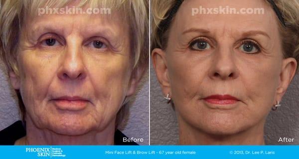 Mini Face Lift and Brow Lift