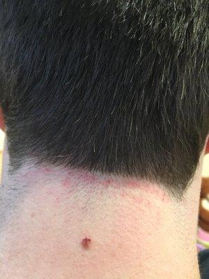 This is my neck after my haircut. It burns.