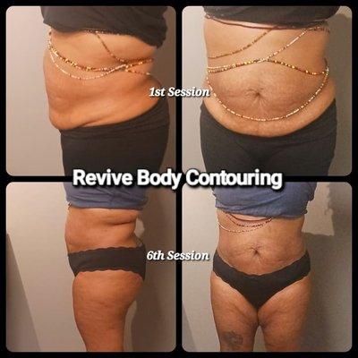 6 sessions of Radio Frequency, Cavitation and Vacuum Therapy. Our Fat Dissolve Body Sculpting Service.  Also good for Chin, Thighs, Arms,etc