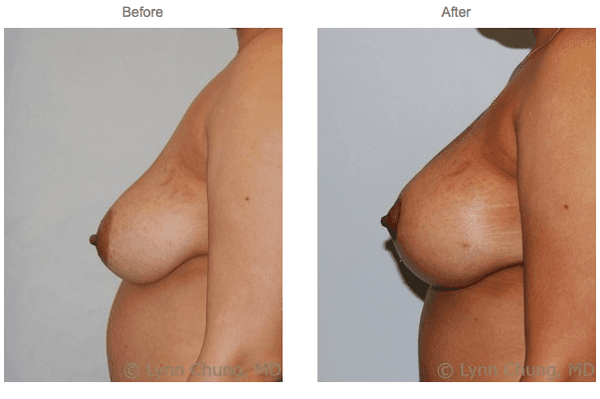 Breast Lift with Implant