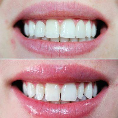 Cosmetic dentistry to enhance our friendly patient's smile.