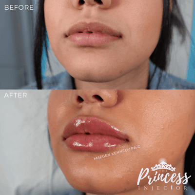 PA Maegen Kennedy's Signature MK Pout - Lip Filler Orlando FL