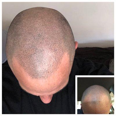 Scalp Micro-Pigmentation 
BOLT 
Valerie
562-712-2007