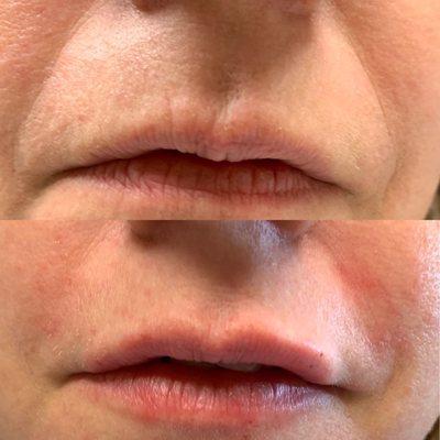 Nasolabial Folds and Lip Filler