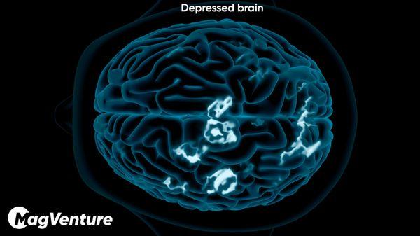 Depressed Brain