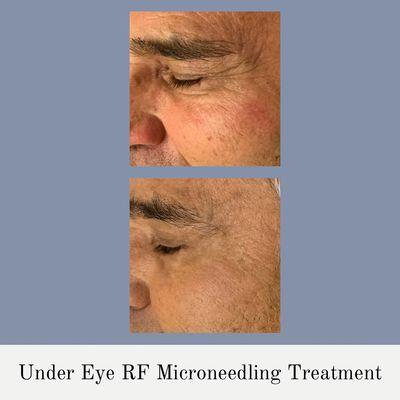 Under Eye RF Microneedling Treatment