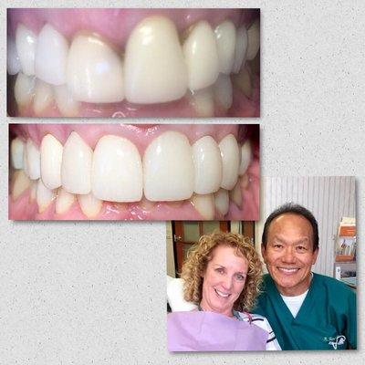 Anne had very uneven gums, and had them cosmetically reshaped, prior to her new porcelain restorations.