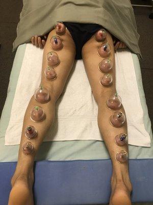 Full-body cupping treatments for men and women.