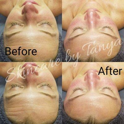 Custom Dermaplaning Infusion Facial with Celluma LED Treatment.