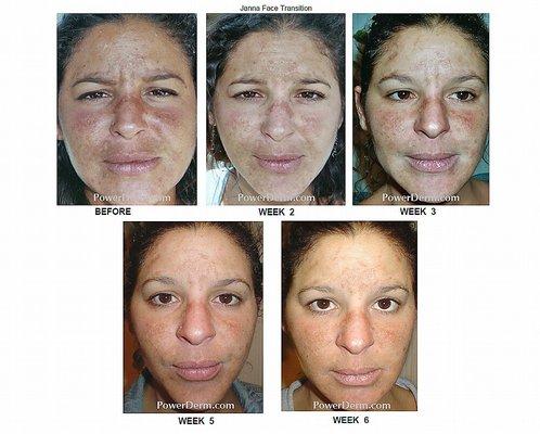 powerkineck dermabrasion peel for melanoma treatment