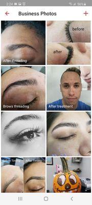 Threading/acne treatment