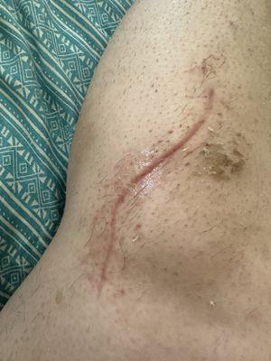 Surgery scars after 2 months