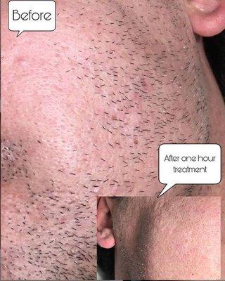 side of face hair removal