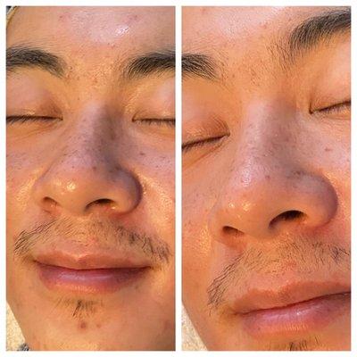 Carbon Mask Facial