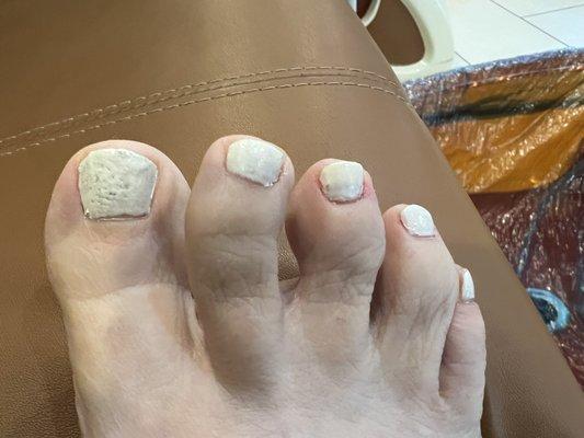 Bad pedicure