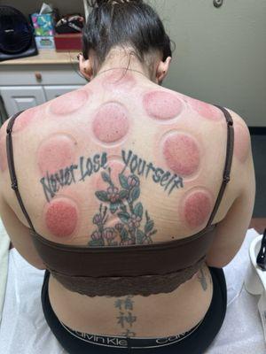 Results after cupping. If you noticed the darker spots are the toxins in my liver.