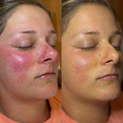 Rosacea facial treatment before and immediately after.