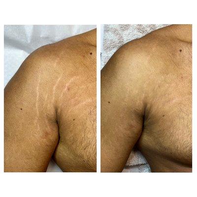 stretch mark camouflage - before & after one session