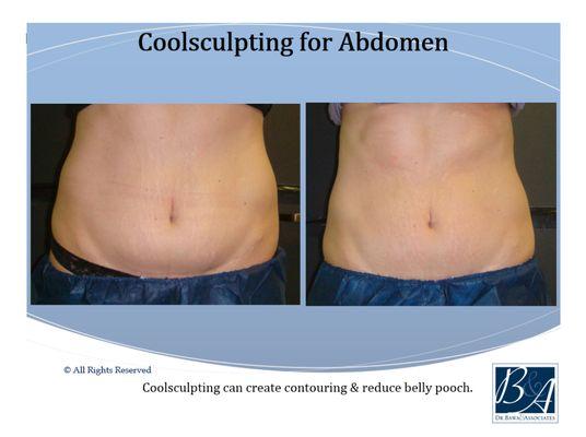 CoolSculpting for Abdomen