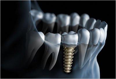 $1879 SINGLE IMPLANT(Includes Implant, abutment, healing cap, zirconia crown, CT scan and Surgical Guide) Bone Graft NOT Included if needed